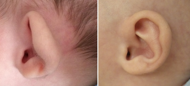 Bat Ear Surgery Dahiphale Hospital