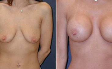 breast-lift-2 breast-lift-2